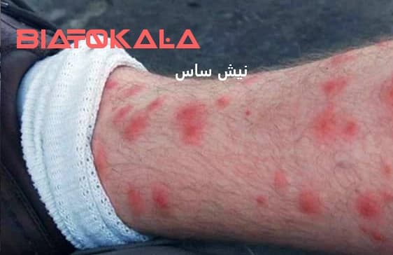 زخم و نیش ساس